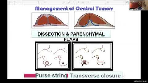 iBreastBook (@ibreastbook) on Twitter photo Many of the previous <a href="/iBreastBook/">iBreastBook</a> #Webinars are available on the webinar playlist on the YouTube channel
Please check and share and subscribe to the channel
iBreastBook Webinar Series
youtube.com/playlist?list=…
#BreastCancer #Oncoplastic #BreastSurgery #BreastReconstruction Many of the previous <a href="/iBreastBook/">iBreastBook</a> #Webinars are available on the webinar playlist on the YouTube channel
Please check and share and subscribe to the channel
iBreastBook Webinar Series
youtube.com/playlist?list=…
#BreastCancer #Oncoplastic #BreastSurgery #BreastReconstruction