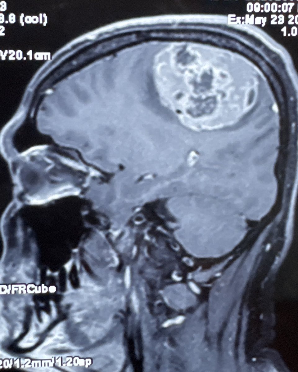 DrSS_Sahoo's tweet photo. Meningioma excision is an art. If crafted meticulously patients improve significantly. This young male presented with seizures and hemiplegia of recent onset and recovered completely. 
#Neurosurgery 
#Braintumor 
#Meningioma https://t.co/FgI0AZwzhj