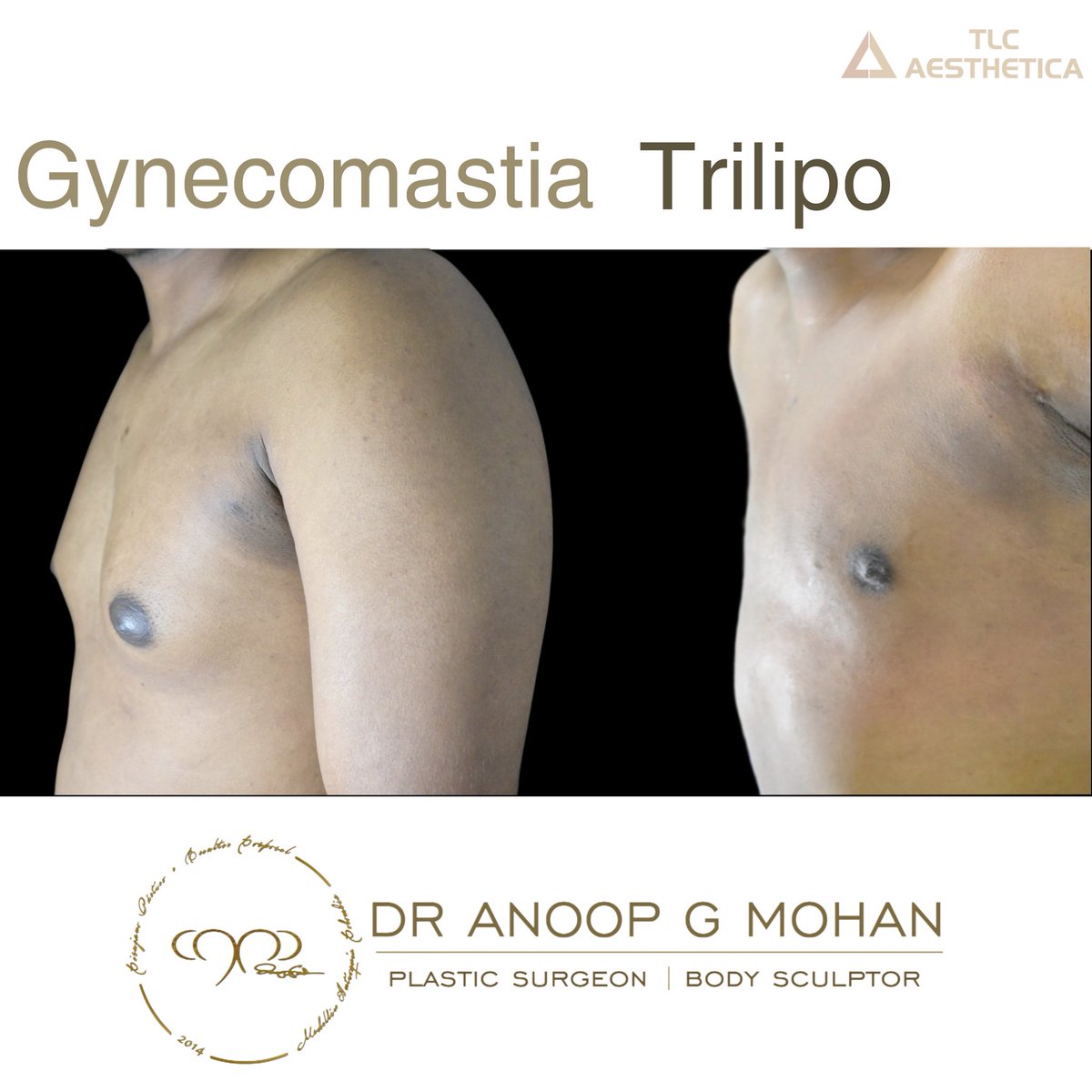 #gynecomastia #trilipo #plasticsurgery #dranoopgmohan