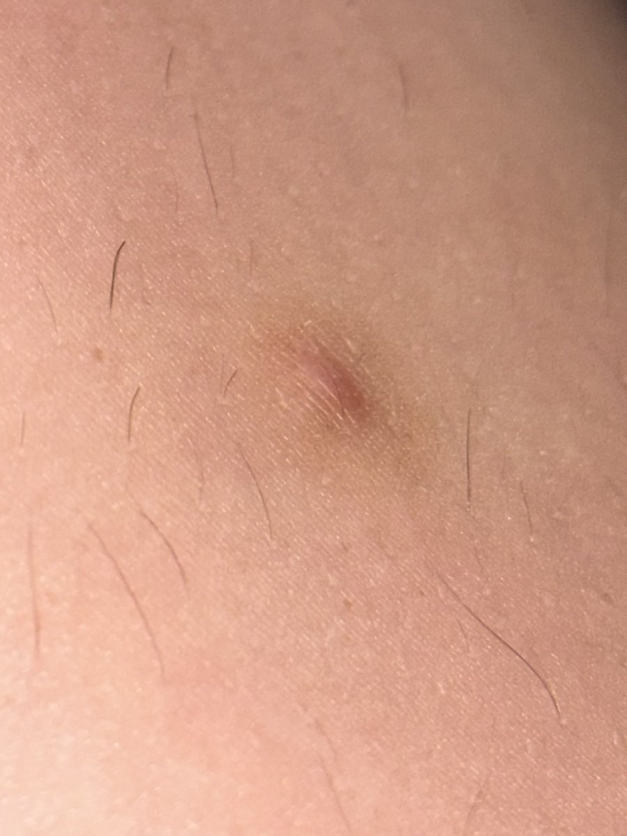 yakamitsuke's tweet photo. c’est un furoncle ? #Health #care #furoncle #Medecine #bouton #svp https://t.co/V4k65SAmuu