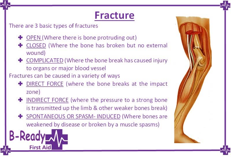 BReadyFirstAid's tweet image. 💜💜💜 Any break is unpleasant &amp;amp; will require time for healing but some are just horrendous.Tell us about yours or someone you know in the comments. 💜💜💜

#BReadyfirstaid #fractures #breaks #openfracture #closedfracture #firstaidtraining #firstaid #firstaidclass #firstaidcourse