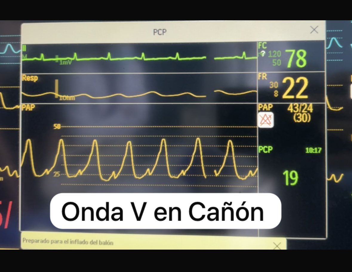 Luis A. Morgado-MD (@drcriticalcare) on Twitter photo Que el Swan Ganz no sirve ???
Test de vasoreactividad pulmonar con nitroglicerina para quitar el componente pos capilar de la HP y saber cuánto componente precapilar tiene la HP y si es candidato a Transplante Cardiaco !!!
Algo que el Eco jamás logrará Realizar !! Que el Swan Ganz no sirve ???
Test de vasoreactividad pulmonar con nitroglicerina para quitar el componente pos capilar de la HP y saber cuánto componente precapilar tiene la HP y si es candidato a Transplante Cardiaco !!!
Algo que el Eco jamás logrará Realizar !!