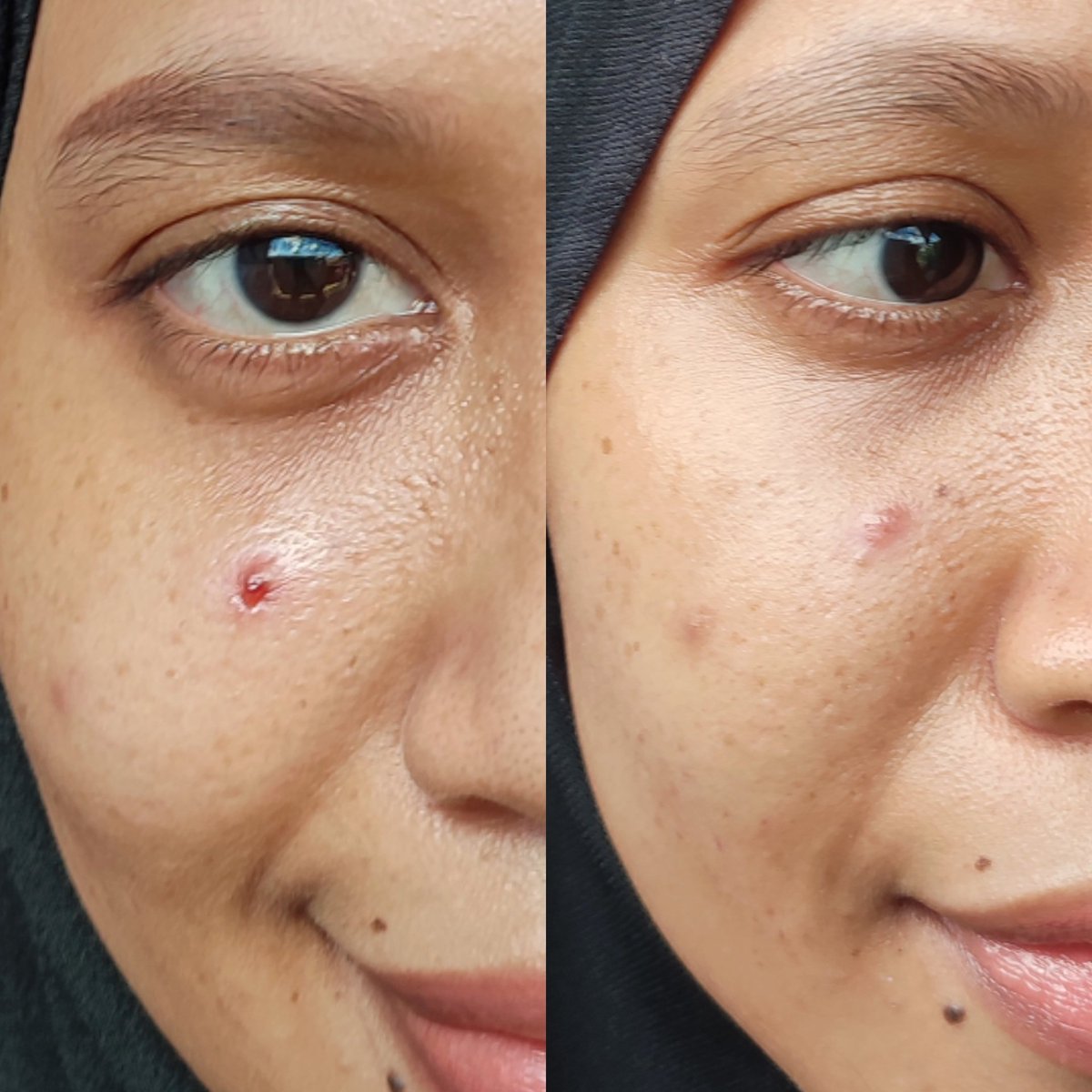 Alhamdulillah udah sembuh, sekarang tinggal bekasnya aja🥹