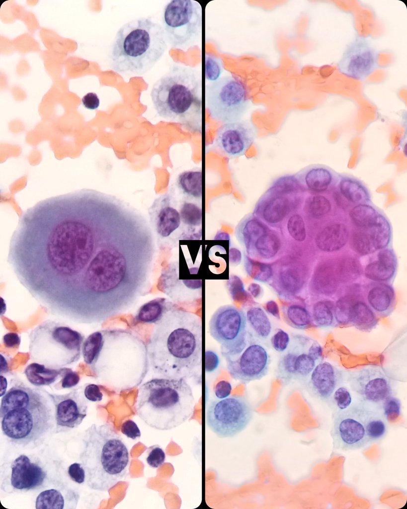 🫁 Pleural effusion.
🔬 Reactive Mesothelial Cell 🆚 Metastatic Carcinoma.

#Cytology #CytoPath #Cttopathology #PathX