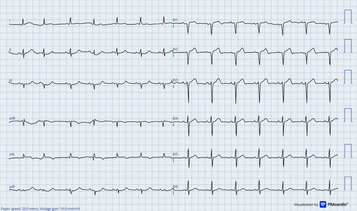 Robert Herman, MD (@roberthermanmd) on Twitter photo Cracked phone or camera lens? No problem!
Fully automated ECG digitization v3 using the <a href="/PMcardioApp/">PMcardio—AI that reads ECGs</a> transforms even the most damaged ECG images into crisp, clean waveforms. Cracked phone or camera lens? No problem!
Fully automated ECG digitization v3 using the <a href="/PMcardioApp/">PMcardio—AI that reads ECGs</a> transforms even the most damaged ECG images into crisp, clean waveforms.