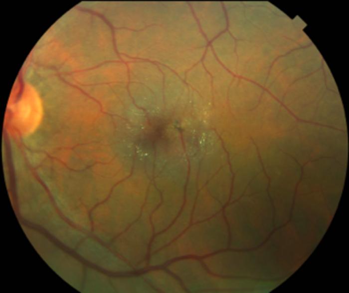 Michael F. Chiang, MD (@neidirector) on Twitter photo Decades of #NIHfunded work in the making:
<a href="/FDA/">FDA</a> approved ENCELTO, a first-of-its-kind eye implant that slows vision loss from macular telangiectasia type 2. <a href="/LowyInstitute/">The Lowy Institute</a> <a href="/NeurotechPharma/">Neurotech Pharmaceuticals</a> <a href="/Moorfields/">Moorfields Eye Hospital NHS Foundation Trust</a>
News from <a href="/scrippsresearch/">Scripps Research</a>: brnw.ch/21wTyvr Decades of #NIHfunded work in the making:
<a href="/FDA/">FDA</a> approved ENCELTO, a first-of-its-kind eye implant that slows vision loss from macular telangiectasia type 2. <a href="/LowyInstitute/">The Lowy Institute</a> <a href="/NeurotechPharma/">Neurotech Pharmaceuticals</a> <a href="/Moorfields/">Moorfields Eye Hospital NHS Foundation Trust</a>
News from <a href="/scrippsresearch/">Scripps Research</a>: brnw.ch/21wTyvr