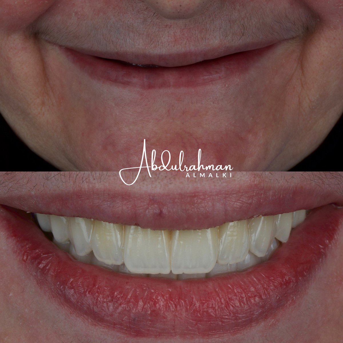 هل يمكن أن تبدو التركيبات الكاملة مع زراعة الأسنان كأنها أسنان طبيعية؟
الجواب: نعم.
في هذه الحالة، المراجعة لم تكن تمتلك أسنانًا منذ فترة طويلة، وتمت إعادة تأهيلها بزراعة وتركيبات ثابتة تُحاكي الأسنان الطبيعية من حيث اللون، الشفافية، والتفاصيل، وبدقة تتناسب مع ملامح الوجه، ولون