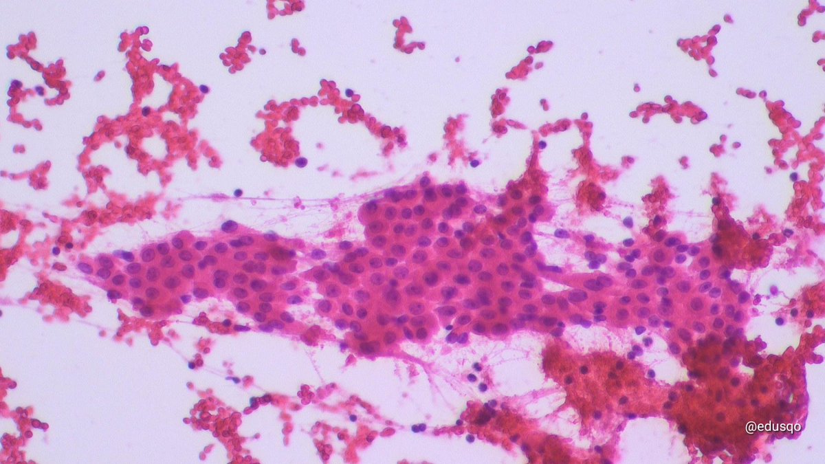 Postal code has a greater impact than the genetic code in some diseases and neoplasms, such as in this Warthin tumor.
El código postal afecta más que el código genético en algunas enfermedades y neoplasias, como este tumor de Warthin
#FNAFriday #CytoPath #MilanSystem #stoptobacco