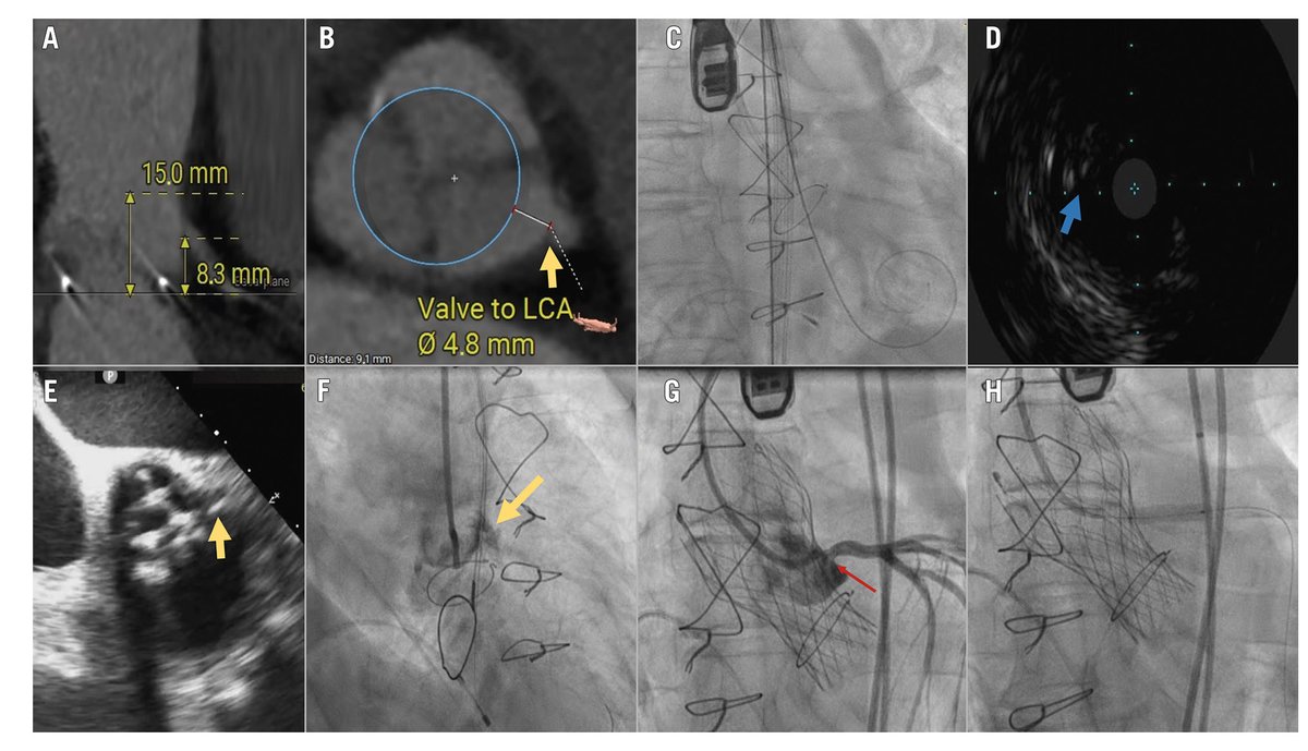 AsiaInterv's tweet image. Even #BASILICA can’t always prevent coronary occlusion during #TAVI—especially with valve misalignment. A must-read case for structural heart teams. 🫀
👉 asiaintervention.org/article/commis…

@APSIC6 @EuroInterventio @PCRonline