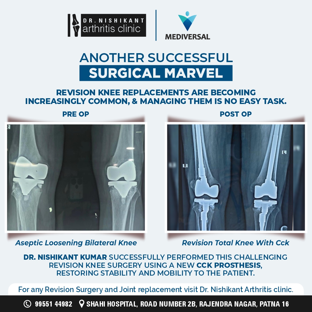 Tackling the Tough Ones: Revision Knee Arthroplasty
Here’s a successful case by Dr. Nishikant Kumar, where a failed knee replacement was corrected using a CCK prosthesis, bringing the patient back to confident movement.

#RevisionKneeSurgery #CCKProsthesis

[Dr. Nishikant Kumar]