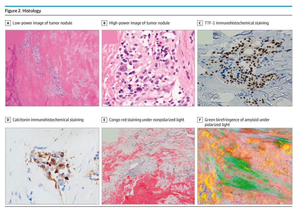 Case report: a patient in their 50s with a suspicious thyroid nodule. ja.ma/4jVIzwy