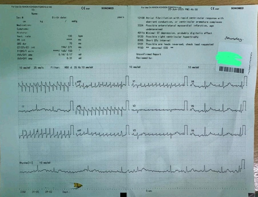 Jagdish Singh (@jagdish26039718) on Twitter photo 60s female, chest pain. Rhythm? <a href="/ecgandrhythmRoe/">Dr. Andreas Roeschl</a> <a href="/ecgrhythms/">Arnel Carmona</a> <a href="/Ecgloverr/">Pedram</a> <a href="/Arron_Pearce_/">Arron Pearce</a> <a href="/ArshadEP277/">Dr Arshad Ali 🇵🇰</a> <a href="/syamkumarmd/">Syamkumar</a> 60s female, chest pain. Rhythm? <a href="/ecgandrhythmRoe/">Dr. Andreas Roeschl</a> <a href="/ecgrhythms/">Arnel Carmona</a> <a href="/Ecgloverr/">Pedram</a> <a href="/Arron_Pearce_/">Arron Pearce</a> <a href="/ArshadEP277/">Dr Arshad Ali 🇵🇰</a> <a href="/syamkumarmd/">Syamkumar</a>