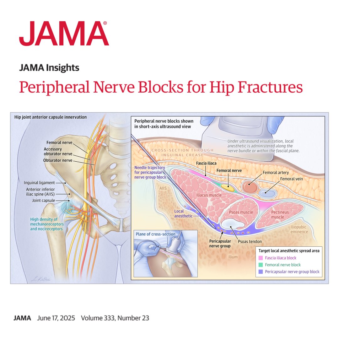 This JAMA Insights explores the use of different types of peripheral nerve blocks as an opioid-sparing pain strategy in the treatment of adults with hip fractures. 

ja.ma/4k1Vm0q