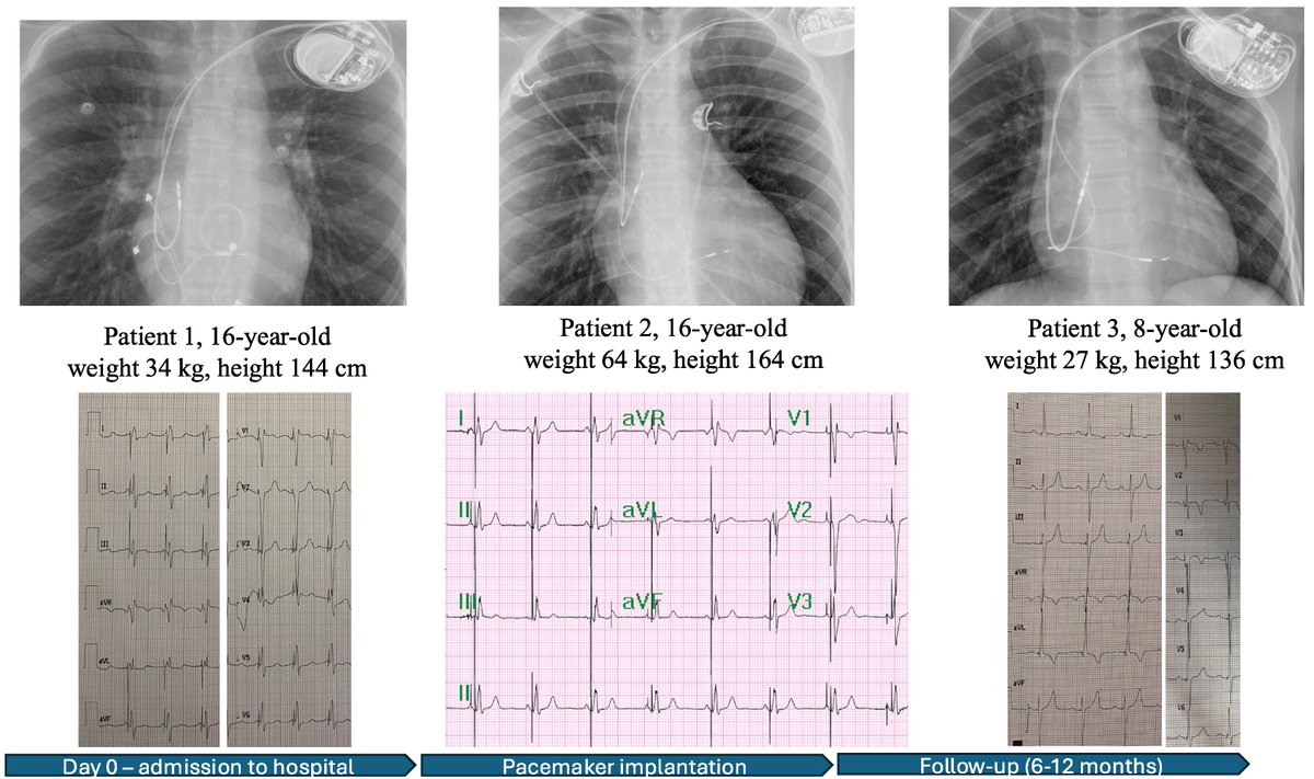 European Society of Cardiology Journals (@esc_journals) on Twitter photo Left bundle branch area pacing in children: case series. ow.ly/YnJw50W5iIJ
#EHJCaseReports <a href="/Phiso_de/">Philipp Sommer</a> <a href="/TJ_Yeo/">Tee Joo YEO</a> <a href="/aayshacader/">Aaysha Cader</a> <a href="/BoldiKovacsMD/">Boldizsar Kovacs</a> <a href="/KardiologieHH/">Erik Rafflenbeul</a> <a href="/ANazmiCalik/">A.Nazmi Calik</a> <a href="/O_Azizy_MD/">Obayda Azizy</a> <a href="/saramoscatelli7/">Sara Moscatelli</a> <a href="/EHJCREiC/">EHJCaseReports Editor-in-Chief</a> #CardioX #EPeeps Left bundle branch area pacing in children: case series. ow.ly/YnJw50W5iIJ
#EHJCaseReports <a href="/Phiso_de/">Philipp Sommer</a> <a href="/TJ_Yeo/">Tee Joo YEO</a> <a href="/aayshacader/">Aaysha Cader</a> <a href="/BoldiKovacsMD/">Boldizsar Kovacs</a> <a href="/KardiologieHH/">Erik Rafflenbeul</a> <a href="/ANazmiCalik/">A.Nazmi Calik</a> <a href="/O_Azizy_MD/">Obayda Azizy</a> <a href="/saramoscatelli7/">Sara Moscatelli</a> <a href="/EHJCREiC/">EHJCaseReports Editor-in-Chief</a> #CardioX #EPeeps