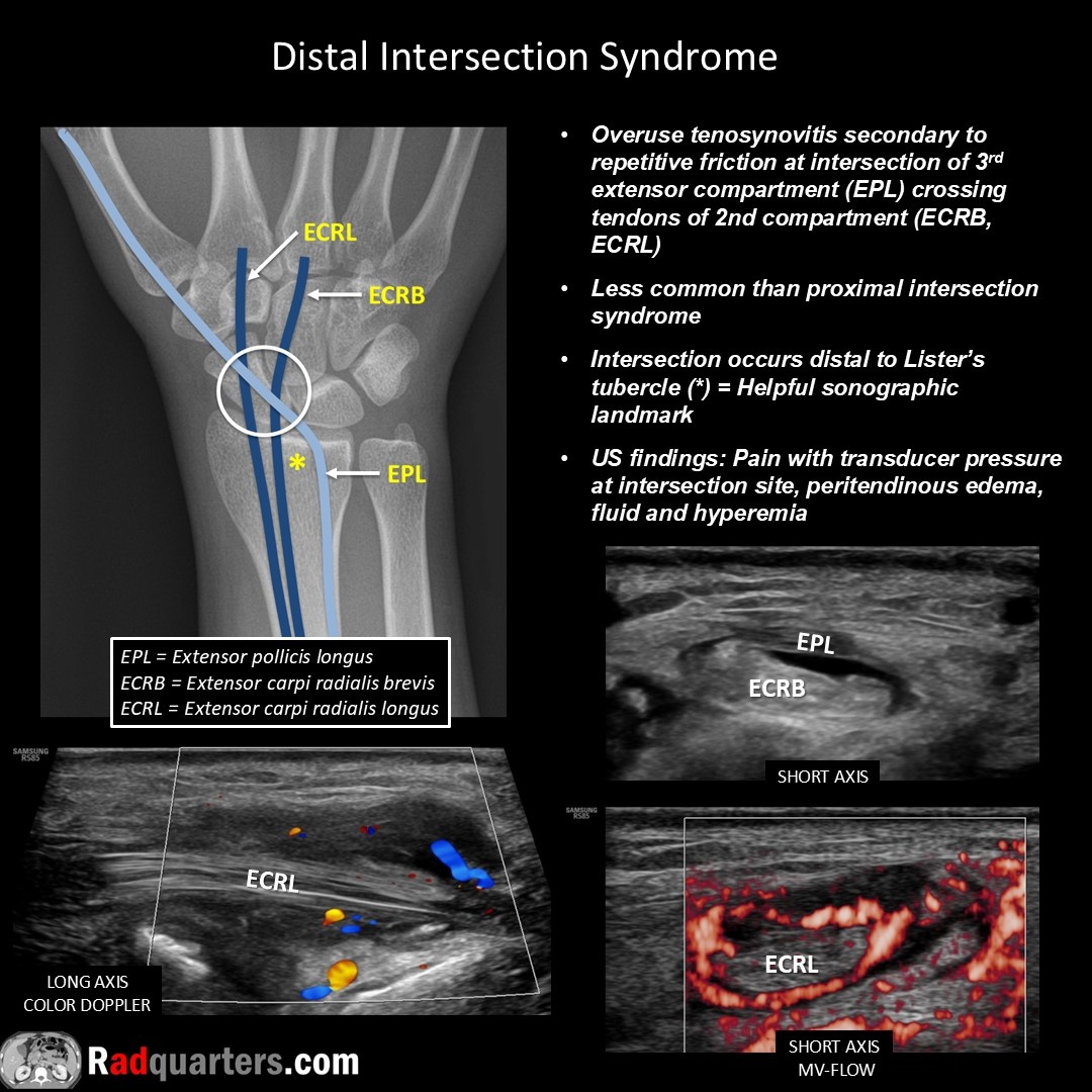 Radquarters's tweet image. 📽️ Watch video to learn more: youtu.be/4gyC2XqCqs4
#FOAMrad #FOAMed #mskrad #usrad #radres #radtech #medstudent #radquarters @BostonImaging @SamsungHealth