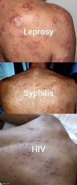 From leprosy to syphilis to AIDS, so-called “diseases” share symptoms and can’t be diagnosed based on clinical features alone. Fictional "pathogens" and unreliable tests uphold the illusion of distinct illnesses—contradictions are dismissed as “coinfections.” Link in comments.