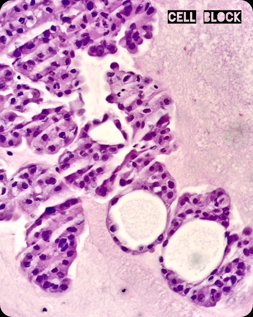 🫁 Lung mass ➕ Pericardial effusion.
🔬 Category 5️⃣ The International System for Reporting Serous Fluid Cytopathology.  Metastatic Adenocarcinoma.
👎🏽 Poor prognosis.

#LungPath #LungCancer #Cytology #Cytopathology
