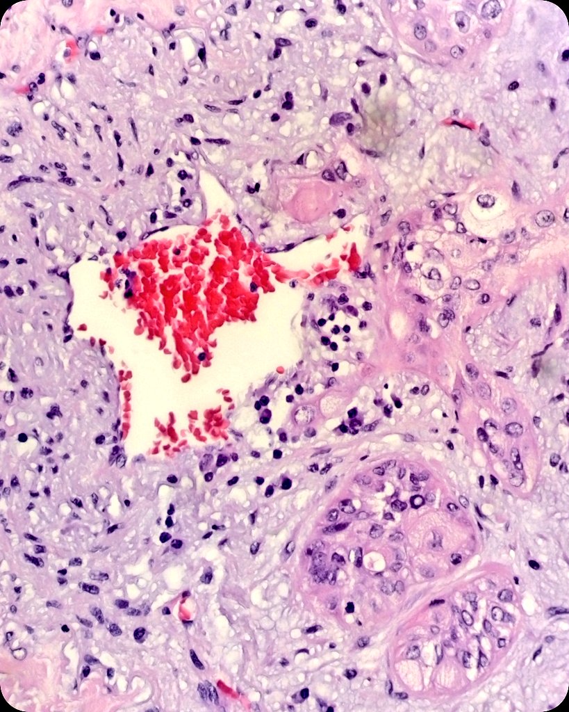 🫁 Lobectomy.  Squamous Cell Carcinoma.
🔬 Arterial wall invasion.

#LungCancer #LungPath #PulmPath