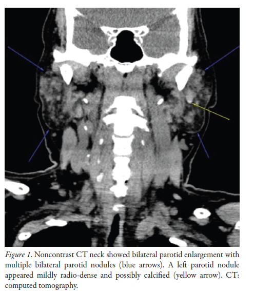 The Journal of Rheumatology (@jrheum) on Twitter photo Images in Rheumatology
Uncommon Clinical and Radiological Presentation of Monosodium Urate Crystal Deposition in Parotid Glands
📖 doi.org/10.3899/jrheum…
<a href="/NUHSofficial/">National University Health System</a>
#monosodiumuratecrystals #parotidgland Images in Rheumatology
Uncommon Clinical and Radiological Presentation of Monosodium Urate Crystal Deposition in Parotid Glands
📖 doi.org/10.3899/jrheum…
<a href="/NUHSofficial/">National University Health System</a>
#monosodiumuratecrystals #parotidgland
