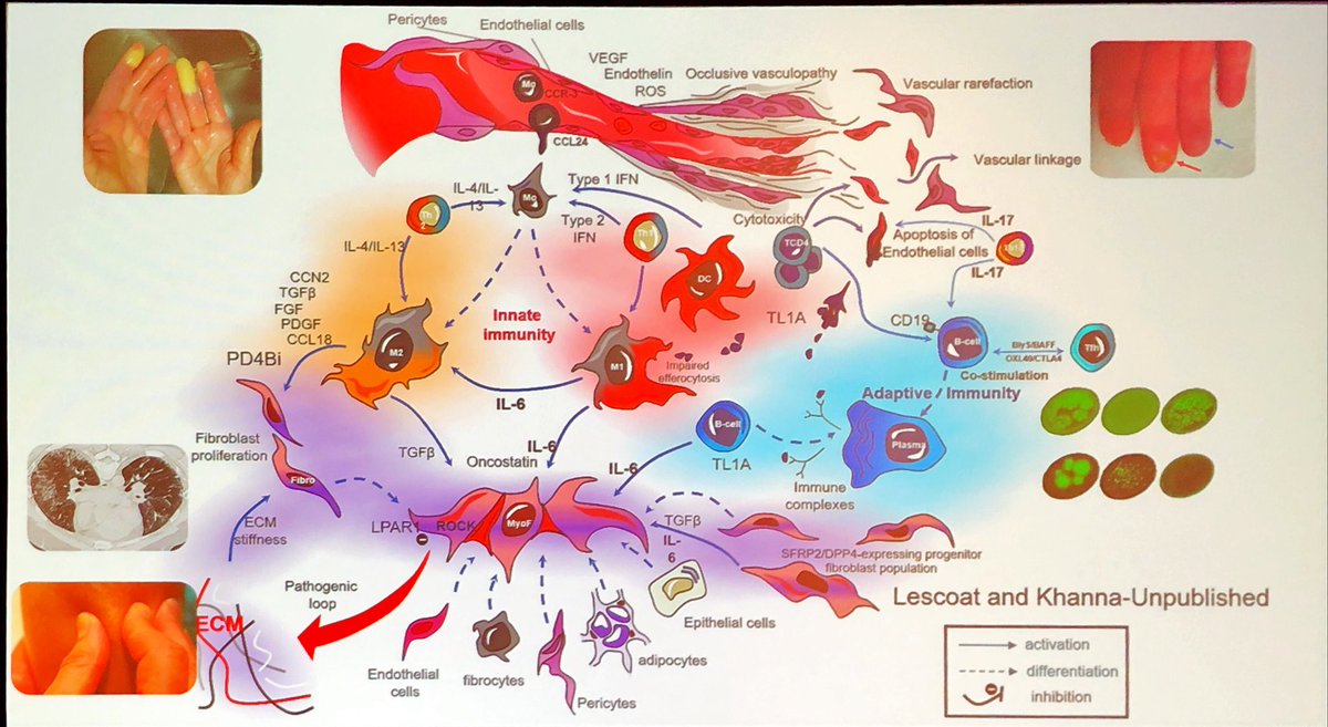 Janetbirdope's tweet image. Hope for people. Living with
#scleroderma 

but 
?too many #trials

Difficult to recruit!

gaps
👇
need to study lcSSc, 
longer disease duration 
?prevention in ⬆️risk #VEDOSS

Dr Dinesh Khanna presents LOADs of #trials 

#FSR2025 @FloridaRheums @RheumNow  @sclerodermaUM