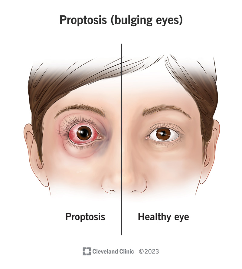 metabolicdang's tweet image. The most noticeable physical symptom I experience when I'm unwell (usually due to hypothyroid symptoms or infections) is bulging, droopy eyes or "prey eyes."
I've seen people develop strict routines to tighten their eyes (lookmaxxing), but an attractive eye area can be…