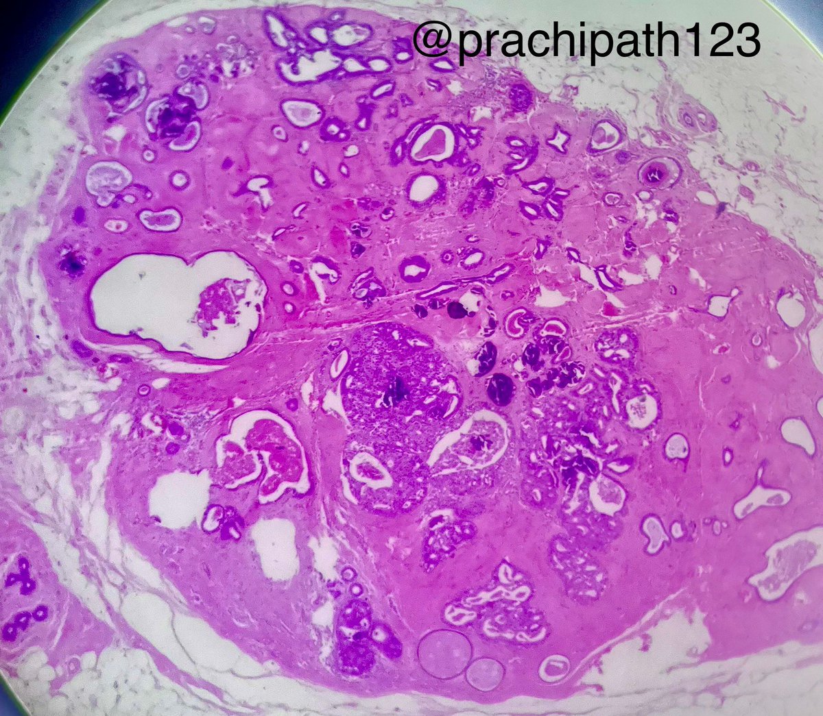 Prachi (@prachipath123) on Twitter photo Yelling alert!
Donโt let benign fool you!
DCIS within fibroadenoma ๐ตโ๐ซ
<a href="/JaredAhrendsen/">Jared T. Ahrendsen MD, PhD (AP/NP/FP)</a> <a href="/adi_agnihotri/">Aditya Agnihotri ๐ฎ๐ณ</a> <a href="/bitar_mireille/">Mireille Bitar, M.D.</a> <a href="/DrCycloPath/">Charlie Herndon</a> <a href="/Kenny92954457/">Kenny De Gracia T.</a> <a href="/Vik_deshpandeMD/">Vikram Deshpande</a> <a href="/IHC_guy/">Andrew Bellizzi ๐บ๐ฆ</a> <a href="/Gloria_SuraMD/">Gloria Sura, MD</a> <a href="/pepeheffernan/">Pepe Jimรฉnez Heffernan</a> <a href="/padmapathology1/">Padma Priya J</a> <a href="/kriyer68/">Kalyani Bambal</a> <a href="/PathologyKate/">Kathryn Lindsey</a> <a href="/DanGrahamMD/">Dan Graham</a> <a href="/Path4People/">Jay "Thymocyte" Hwang</a>
๐โโ๏ธ๐๐ญ Yelling alert!
Donโt let benign fool you!
DCIS within fibroadenoma ๐ตโ๐ซ
<a href="/JaredAhrendsen/">Jared T. Ahrendsen MD, PhD (AP/NP/FP)</a> <a href="/adi_agnihotri/">Aditya Agnihotri ๐ฎ๐ณ</a> <a href="/bitar_mireille/">Mireille Bitar, M.D.</a> <a href="/DrCycloPath/">Charlie Herndon</a> <a href="/Kenny92954457/">Kenny De Gracia T.</a> <a href="/Vik_deshpandeMD/">Vikram Deshpande</a> <a href="/IHC_guy/">Andrew Bellizzi ๐บ๐ฆ</a> <a href="/Gloria_SuraMD/">Gloria Sura, MD</a> <a href="/pepeheffernan/">Pepe Jimรฉnez Heffernan</a> <a href="/padmapathology1/">Padma Priya J</a> <a href="/kriyer68/">Kalyani Bambal</a> <a href="/PathologyKate/">Kathryn Lindsey</a> <a href="/DanGrahamMD/">Dan Graham</a> <a href="/Path4People/">Jay "Thymocyte" Hwang</a>
๐โโ๏ธ๐๐ญ