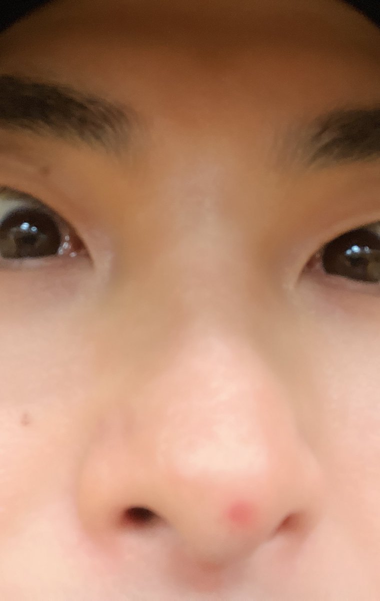 加藤と今日は撮影。

おもろいのやってくので、応援していただければ！！🥹

しかし、最近お肌調子悪く鼻のてっぺんにおできてん。。