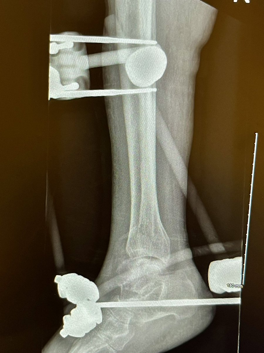 DrSipala's tweet photo. 💥 Displaced bimalleolar fracture 💥 

Compromised skin with presence of fracture blisters; objective is to restore anatomical alignment and re-establish fibular length. The @strykerfa Delta frame allows us to pursue this goal despite the challenging skin condition. https://t.co/Ri743ov0RW