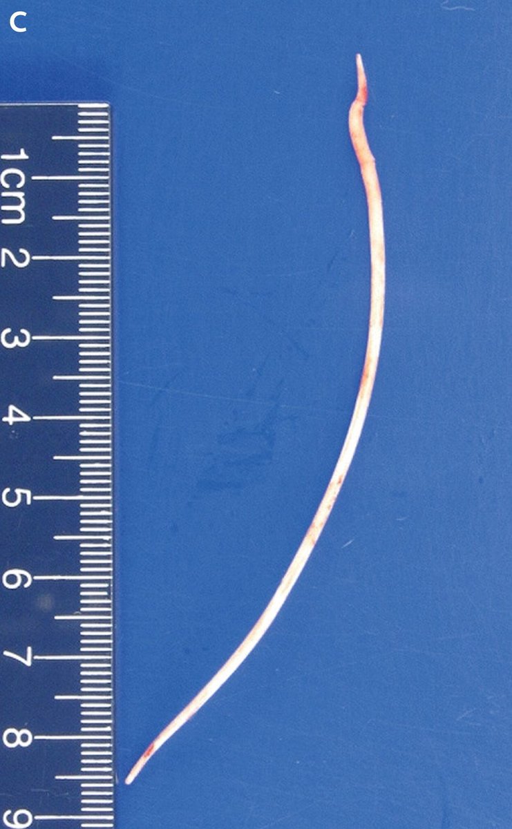 A 4-inch piece of cement from a routine spinal procedure pierced a man’s heart, nearly killing him.

How did something meant to fix his back become a death sentence?

The shocking turn of events will leave you stunned.

This is his story: