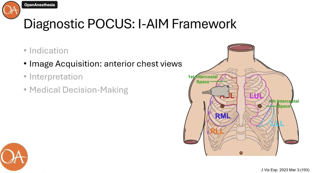IARS360 (@iars360) on Twitter photo Check out the <a href="/openanesthesia/">OpenAnesthesia®</a> POCUS Case of the Month on Lung Ultrasound! Thoughts? Don't miss this episode! #Anesthesia #POCUS #LungUltrasound #MedicalEducation #AnesthesiaCommunity #UltrasoundGuided #PatientCare #Vodcast #ClinicalPractice ow.ly/FZsk50W9e5c Check out the <a href="/openanesthesia/">OpenAnesthesia®</a> POCUS Case of the Month on Lung Ultrasound! Thoughts? Don't miss this episode! #Anesthesia #POCUS #LungUltrasound #MedicalEducation #AnesthesiaCommunity #UltrasoundGuided #PatientCare #Vodcast #ClinicalPractice ow.ly/FZsk50W9e5c