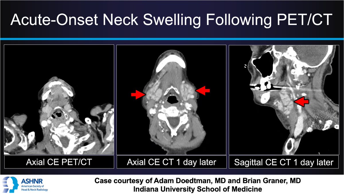 ASHNRSociety's tweet image. #ASHNRCOTW #302: ANSWER. Drs. Doedtman + Graner 4 case! #ASHNR25
@callyrobs @DShatzkes @CDP_Rad @rhwiggins
@nakoontz @KRileyMD @CMGlastonbury @tabby_kennedy @PhilipRChapman1 @cmtomblinson
@amyfjuliano @bpoliceni @MohitTCCNeuro @AshokSrini15 @KatieTraylorDO @CynXinWu