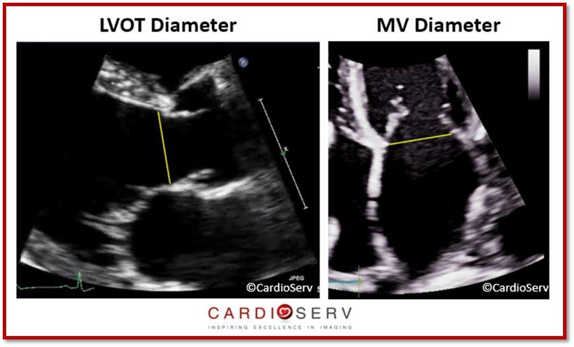 Quantifying MR via Stroke Volume Method using LVOT and MV VTI. Loosing more forward stroke volume = more regurgitation/back flow.
#POCUS #FOAMed #Nephpearls 
🔗 cardioserv.net/echo-sv-method…