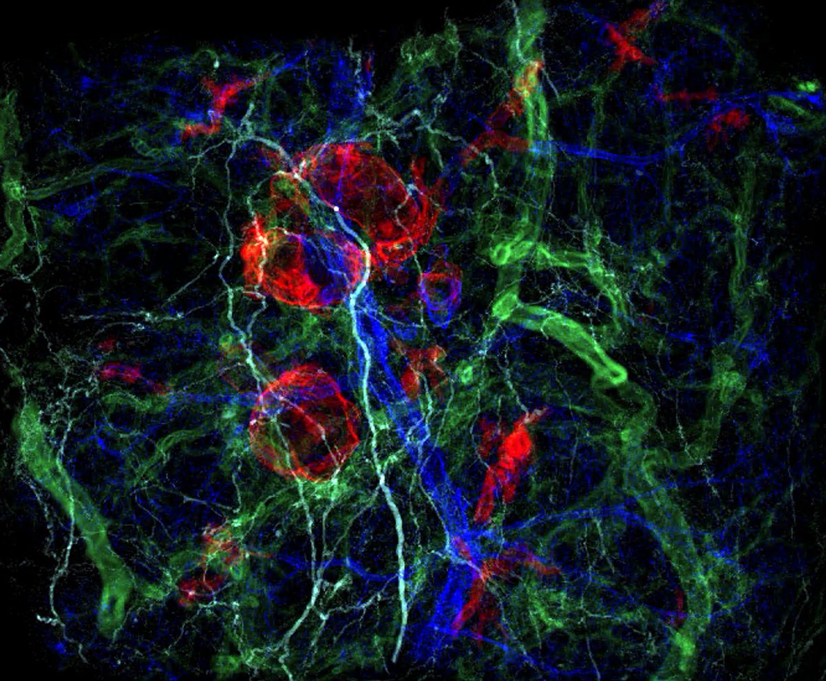 deniswirtz's tweet image. CODA reveals two different types of pre-cancer lesions in the human pancreas.
CODA can map large volumes of tumors/tissues in 3D and at single-cell resolution.
Red, PanIN lesions; navy blue: duct; light blue: nerve; green: blood vessel