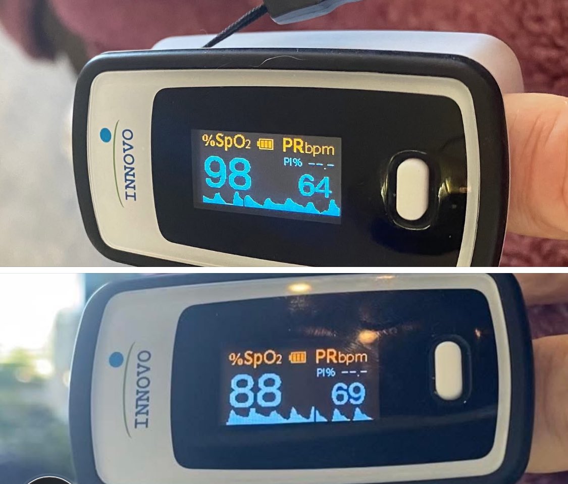 mmcbridemd's tweet image. Life for an athletic runner after long covid. No vaccines (ie no contributing vaccine injury).
When histamine issues and dysautonomia make simply eating breakfast a dangerous undertaking.
Appreciate the acknowledgement of #LongCovid and the support of @HHSGov @NIHDirector_Jay