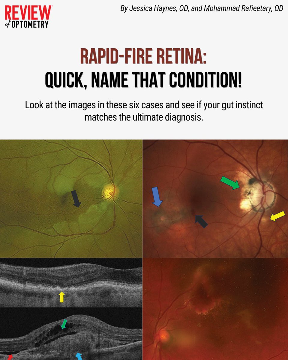 Put your diagnostic skills to the test with six real-world retina cases. Can you guess any of these diagnoses based on the images alone? 🤔

Click here to take the challenge: reviewofoptometry.com/article/rapidf…
#optometry #retina #retinaldisease #eyedoctor #AMD #maculardegeneration