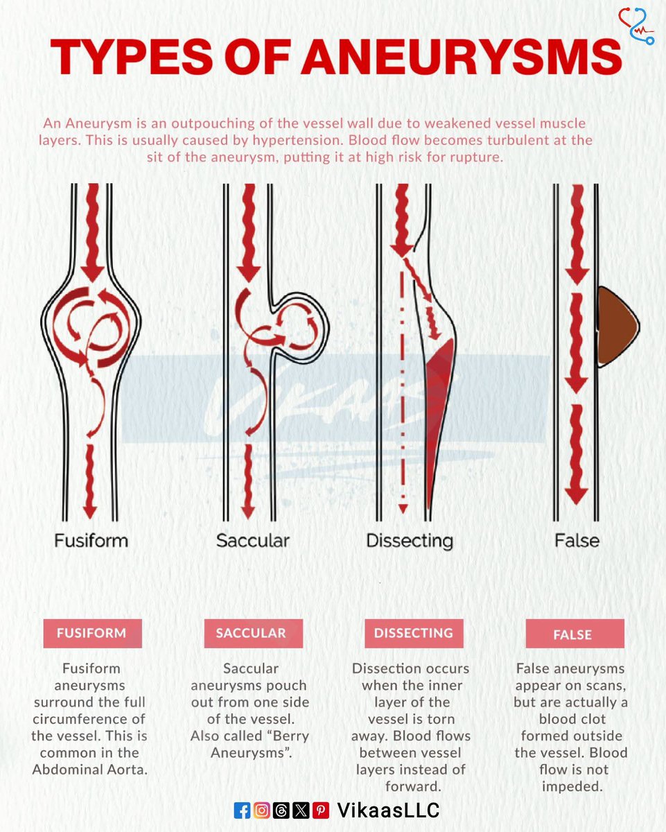 Aneurysms