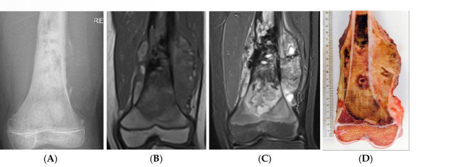 Happy to share my 400th publication <a href="/ROHImaging/">ROHImaging</a> <a href="/ROHNHSFT/">The Royal Orthopaedic Hospital</a> <a href="/ESSRmsk/">European Society of Musculoskeletal Radiology</a> <a href="/BSSR_Site/">BSSR</a> <a href="/intskeletal/">International Skeletal Society | ISS</a> <a href="/MSKSocietyIndia/">MSS India</a> <a href="/Heath_Lodge/">Heath Lodge Clinic</a> <a href="/ClinRadiology/">Clinical Radiology</a>