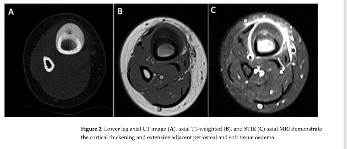 mskradiology4u1's tweet photo. Happy to share my 400th publication @ROHImaging @ROHNHSFT @ESSRmsk @BSSR_Site @intskeletal @MSKSocietyIndia @Heath_Lodge @ClinRadiology https://t.co/Z3Uo9uMaKx