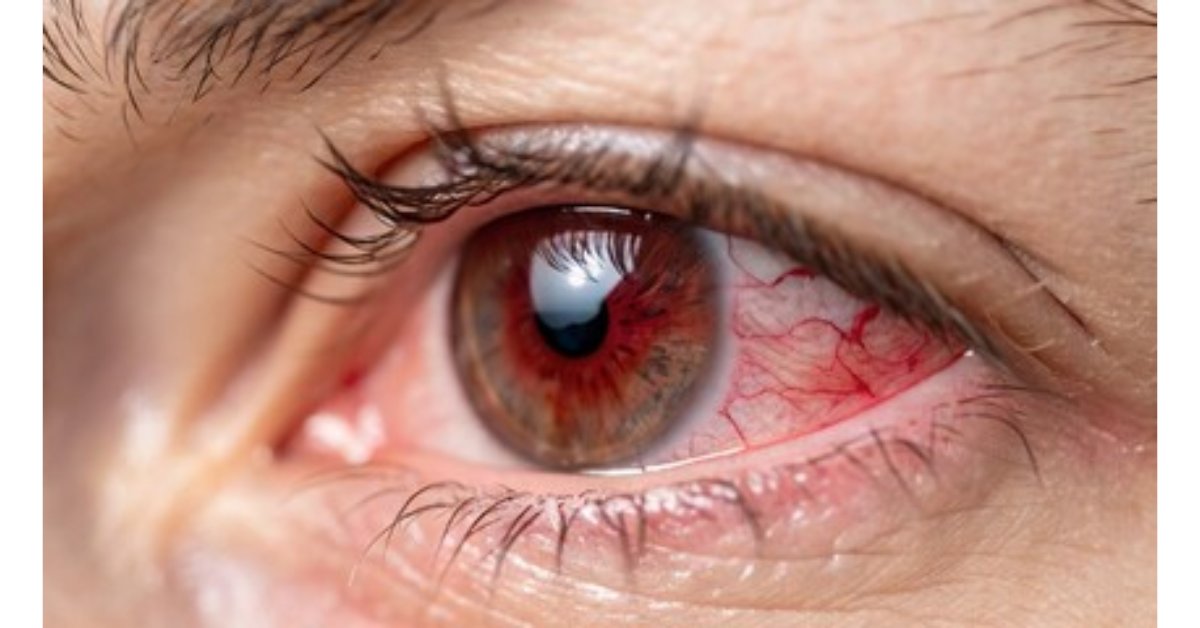 Summertime and photos? Great. 🌞📷 

Summertime and #photokeratitis? Not so much.

Learn how to protect your eyes from their own version of #sunburn with resources from the American Academy of Ophthalmology (<a href="/aao_ophth/">AAO</a>).: brnw.ch/21wTyTE

#EyeProtection #SunProtection