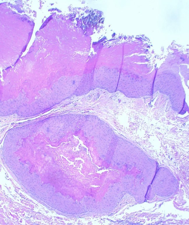 JCandidoXavier's tweet photo. Proliferating trichilemmal tumour

Not malignant or benign
Just a low malignant potential tumor.

Scalp is the typical site

It is Like a pilar cyst, but with prominent epithelial infoldings

Calcification is common

#path #derm #Dermatopathology #pathology https://t.co/9nd1LmtxDA