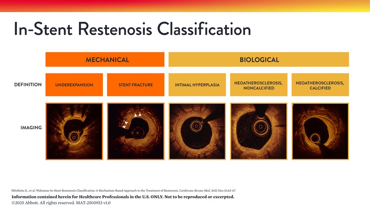 🧵1/6 | In-stent restenosis (ISR) treatment occurs in ~10% of US #PCI (CV Data Registry). A 🔑 factor in ISR treatment is identifying the cause of #Stent failure.

Follow along as we discuss ISR causes, assessments, and treatment.👇🏼

Safety Info: bit.ly/OCT_ISI