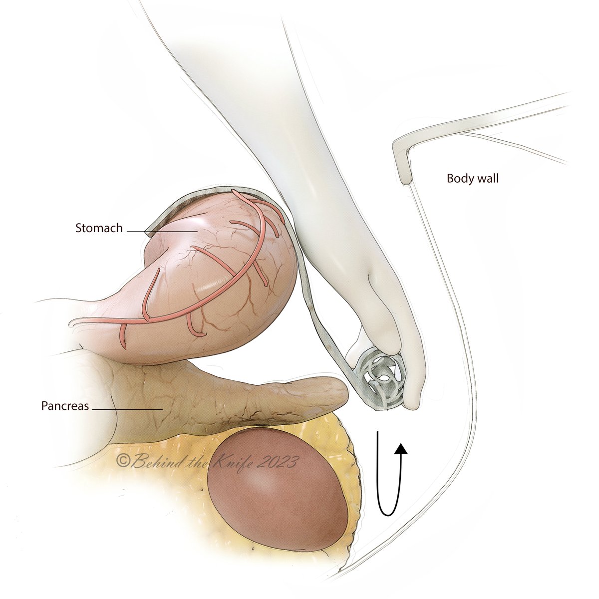 To check for bleeding after a splenectomy:

✔️ Fold a lap pad into thirds
✔️ Unroll it into the furthest reaches of the LUQ
✔️ Roll it back up slowly, identifying bleeding as you go