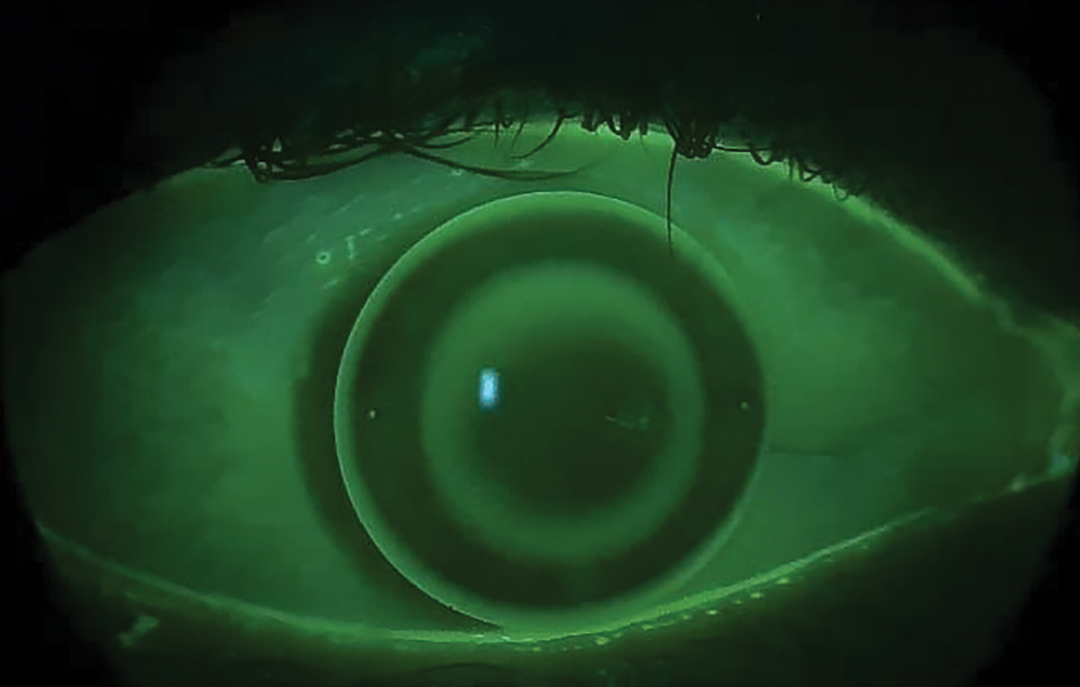 Ortho-K Displays More Favorable Outcomes in Older Children

Contrary to the paradigm that earlier intervention is always better, researchers found those with refractive error of -3.00D or less also had better responses.
reviewofoptometry.com/article/orthok…
#cornea #optometry #eyecare