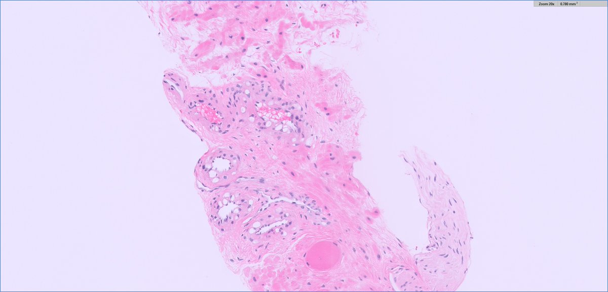admittedly hard off 1 image...but if PIN4 had been done I suspect % at "atypia/ASAP" might have been even higher (basal markers would be NEG btw, and no AMACR)

Dx: just vacuolated change in a vessel (see more pics/levels here)

#beautyinb9 but Huge Jass 🔬potential pitfall!