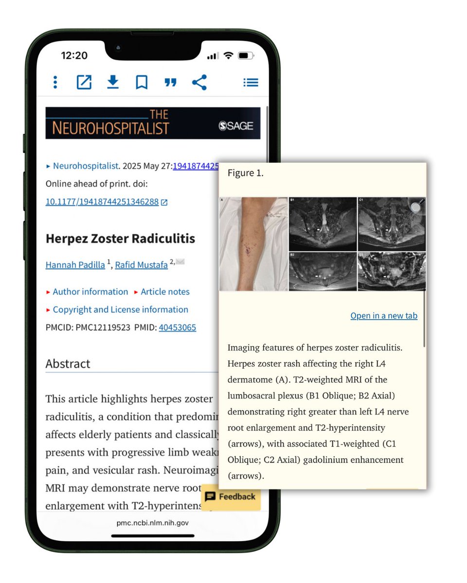 Neurohosp's tweet image. New Research Herpes zoster radiculitis
New case report co-authored by NHS Treasurer Dr. @RafidMustafa (@MayoClinic ) highlights under-recognized cause of limb weakness & pain in older adults
✅ MRI + CSF VZV PCR ✅ Acyclovir + gabapentin
🔗 pmc.ncbi.nlm.nih.gov/articles/PMC12…
#NeuroTwitter