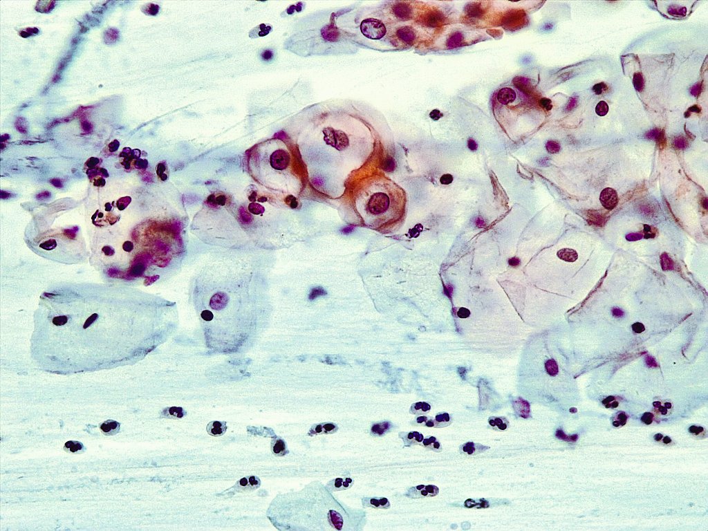 Diffent shapes and sizes of koilocytes.