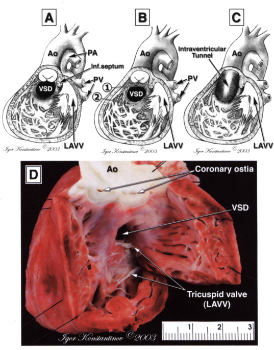 A view from the morphologically right ventricle shows subaortic conus.