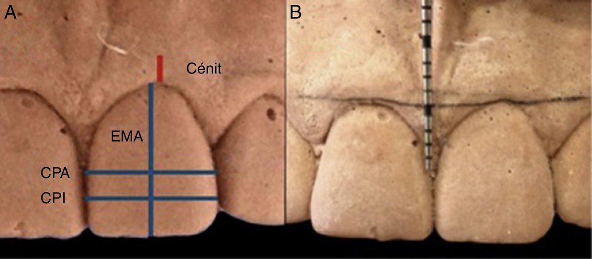 ℹ️ ¿Qué es el Cenit Gingival y por qué es clave en la estética dental?

El Cenit Gingival se define como el punto más apical del margen gingival de un diente. No se encuentra en el centro del diente, sino ligeramente desplazado hacia distal, especialmente en los incisivos