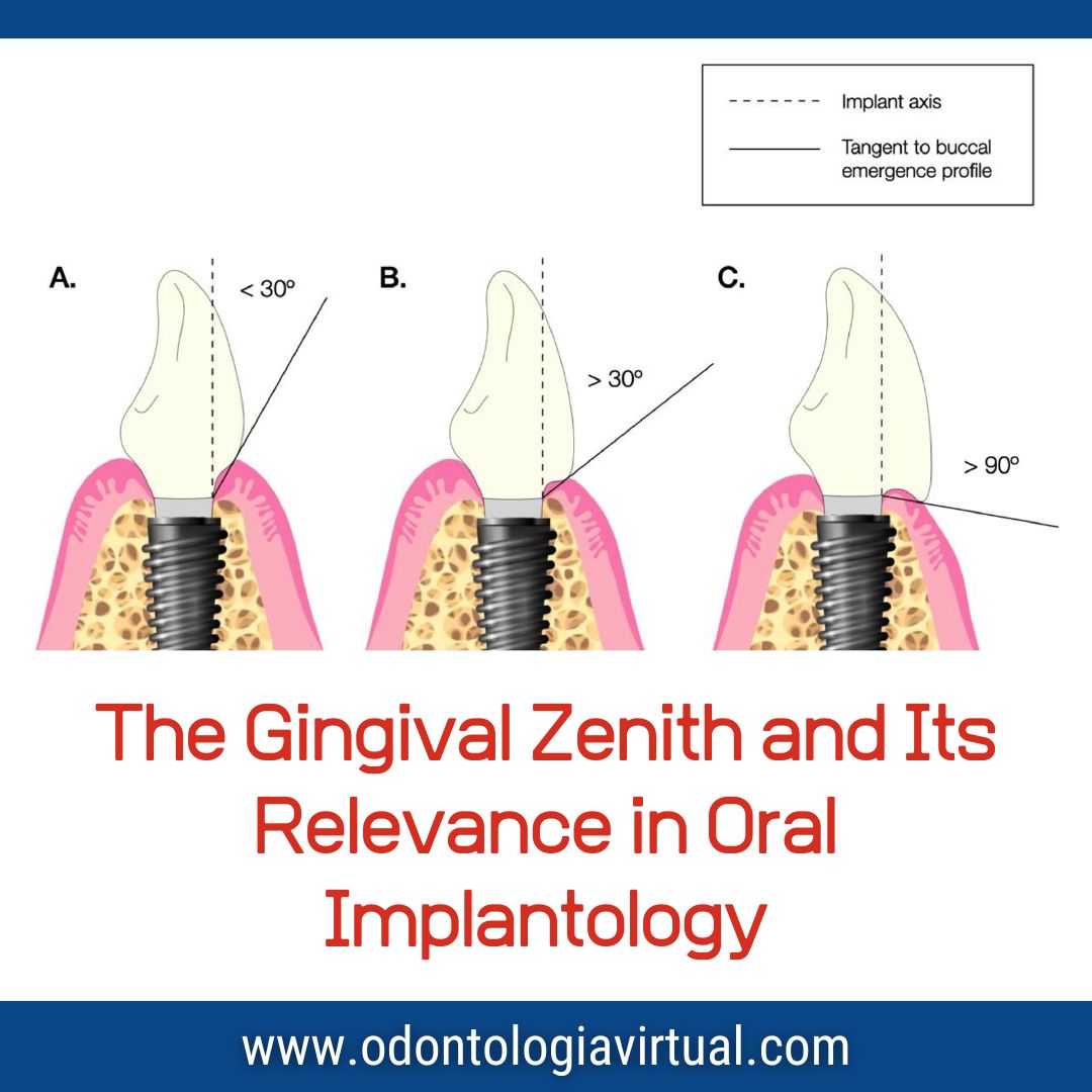 LINK odontologiavirtual.com/2025/06/the-gi… 

A critical yet often underappreciated parameter in this pursuit is the gingival zenith — the highest point of the gingival margin contour around each tooth or implant crown.

In anterior implant restorations, especially in the esthetic zone, proper