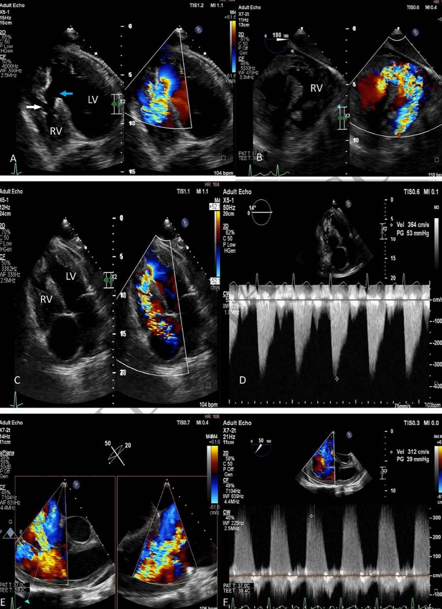 EHJ-IMP Editor-in-Chief (@ehjimpeic) on Twitter photo #EHJIMP An educational case of traumatic VSD and moderator band injury from missed stab wound is being described by Dr Mel 🇿🇦➡️ academic.oup.com/ehjimp/advance… <a href="/ESC_Journals/">European Society of Cardiology Journals</a> <a href="/escardio/">European Society of Cardiology</a> <a href="/alessia_gimelli/">Alessia Gimelli</a> <a href="/EACVIPresident/">EACVI President</a> <a href="/pabloplopez_/">Pablo Pérez López</a> <a href="/JGrapsa/">Julia Grapsa MD, PhD</a> <a href="/EZancanaroMD/">Edoardo Zancanaro MD</a> <a href="/BenekiEirini/">Eirini Beneki</a> <a href="/ShehabAnwer/">Shehab Anwer, MD</a> #EHJIMP An educational case of traumatic VSD and moderator band injury from missed stab wound is being described by Dr Mel 🇿🇦➡️ academic.oup.com/ehjimp/advance… <a href="/ESC_Journals/">European Society of Cardiology Journals</a> <a href="/escardio/">European Society of Cardiology</a> <a href="/alessia_gimelli/">Alessia Gimelli</a> <a href="/EACVIPresident/">EACVI President</a> <a href="/pabloplopez_/">Pablo Pérez López</a> <a href="/JGrapsa/">Julia Grapsa MD, PhD</a> <a href="/EZancanaroMD/">Edoardo Zancanaro MD</a> <a href="/BenekiEirini/">Eirini Beneki</a> <a href="/ShehabAnwer/">Shehab Anwer, MD</a>